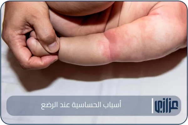 أسباب الحساسية عند الرضع