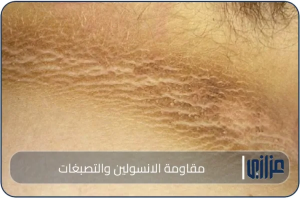 مقاومة الانسولين والتصبغات