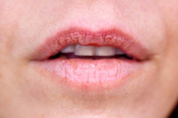 رعاية البشرة الجافة في الشتاء