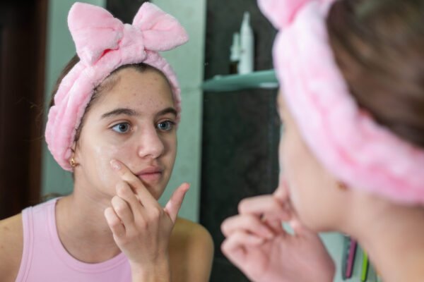 مشاكل البشرة في سن المراهقة وتأثير الهرمونات والتوتر